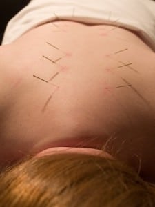 acupuncture-needles-back
